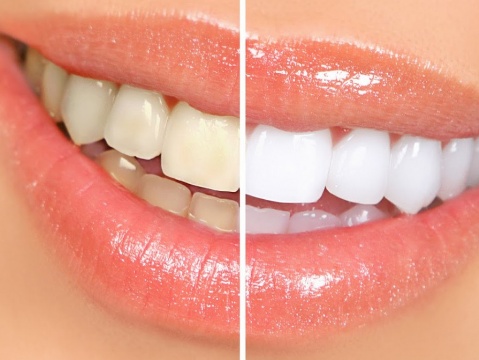 Blanqueamiento Dental